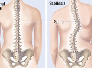 Understanding Scoliosis